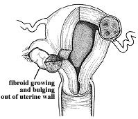 Fibroid diagram