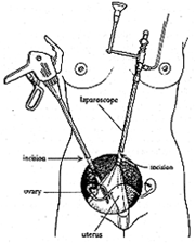Hysterectomy diagram